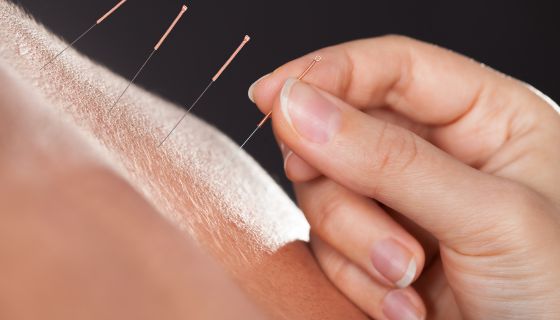 Acupuncture